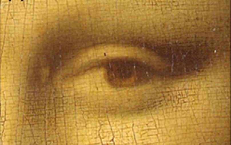 Mona Lisa illnesses: Leonardo di ser Piero da Vinci, Portrait of Lisa Gherardini, ca. 1503–19, Louvre Museum, Paris. Xanthelasma: lesion related to lipids.