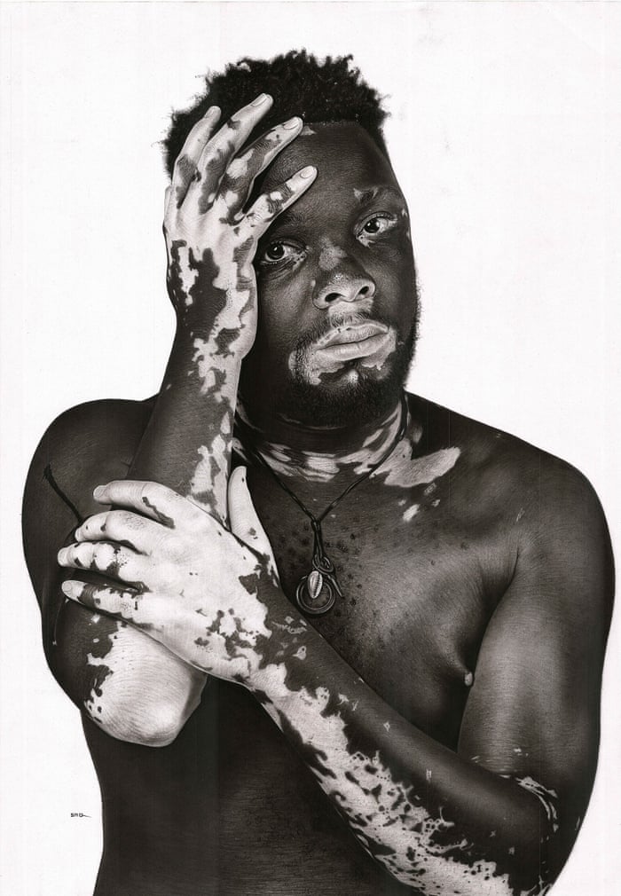 Martin Senkubuge, Vitiligo King, 2020.