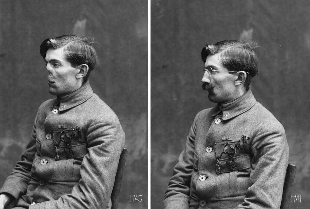 Anna Coleman Ladd: French soldier fitting a mask by Anna Coleman Ladd (view before and after), 1918, Library of Congress, Washington, DC, USA. Library’s website.
