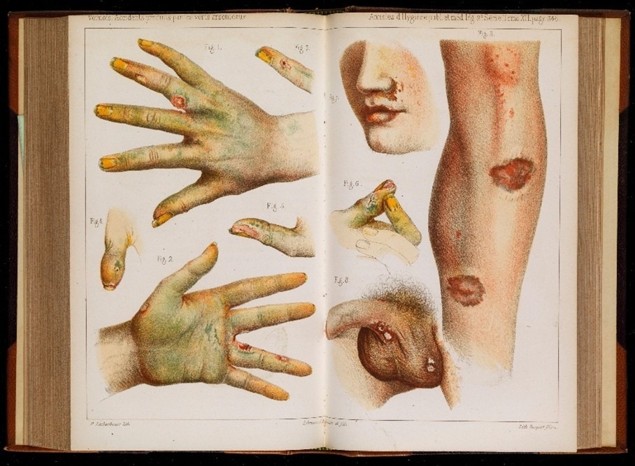painters pigments: Illustration from a French medical journal in 1859 showing typical damage on hands when exposed arsenical dyes, 1859, Wellcome Collection, London, UK. The TMC Library.
