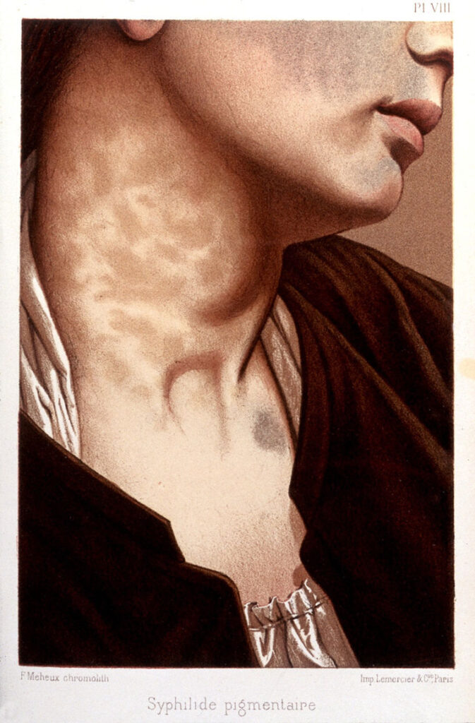 Victorian Syphilis: George Henry Fox, Cutaneous Syphilis, 1881, Wellcome Collection, London, UK.
